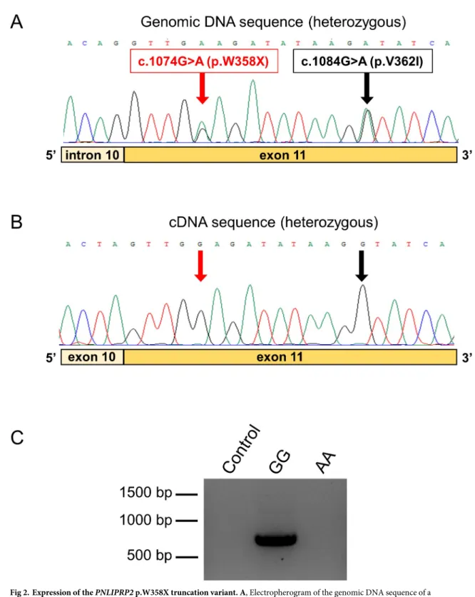 Fig 2. Expression of the PNLIPRP2 p.W358X truncation variant. A, Electropherogram of the genomic DNA sequence of a