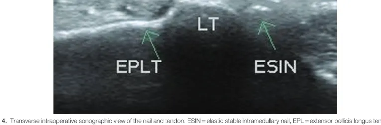 Figure 5. Longitudinal intraoperative sonographic view of the nail and the radius: Extensor pollicis longus tendon is not visualized.