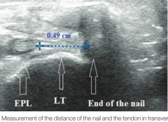 Figure 7. Measurement of the distance of the nail and the tendon in transverse sonographic view
