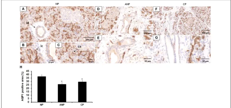 FIGURE 6 | Expression of AQP1 in patients with acute and chronic pancreatitis. Representative histological images show expression and localization of AQP1 in normal human pancreas (NP, A–C) acute necrotizing pancreatitis (ANP, D,E) and chronic pancreatitis