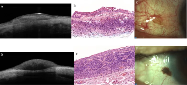 Fig 5. Subepithelial conjunctival naevus: anterior segment optical coherence tomography (AS-OCT) (A); histopathological appearance (B,