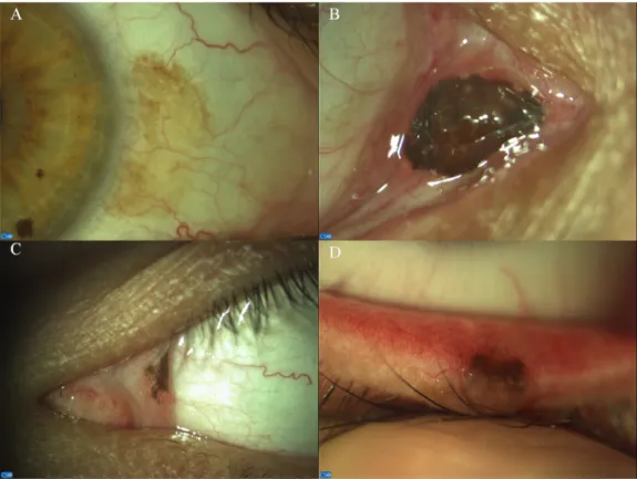 Fig 1. Localization of conjunctival naevi: Bulbar (A), caruncular (B), plical (C), intermarginal (D).