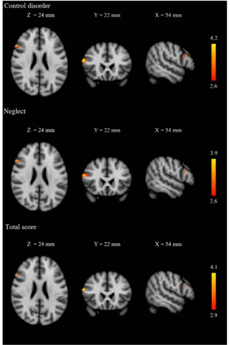 Figure 1. Voxelwise analysis of the frontal cortex. Red – yellow indicate voxels demonstrating signi ﬁ cant positive correlation between the amount of gray matter mass in pars opercularis and PIUQ scores in females