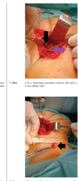 6. ábra Az a. carotis externa, illetve a canalis vasovagorum kipreparálása  (zöld nyíl)