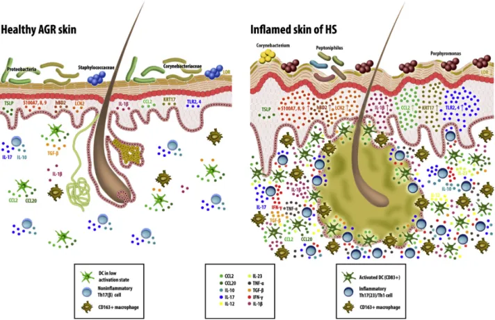 Figure 1. Apocrine glanderich skin has a non-inflammatory IL-17erelated immune milieu, which turns to inflammatory IL-17emediated disease in hidradenitis suppurativa