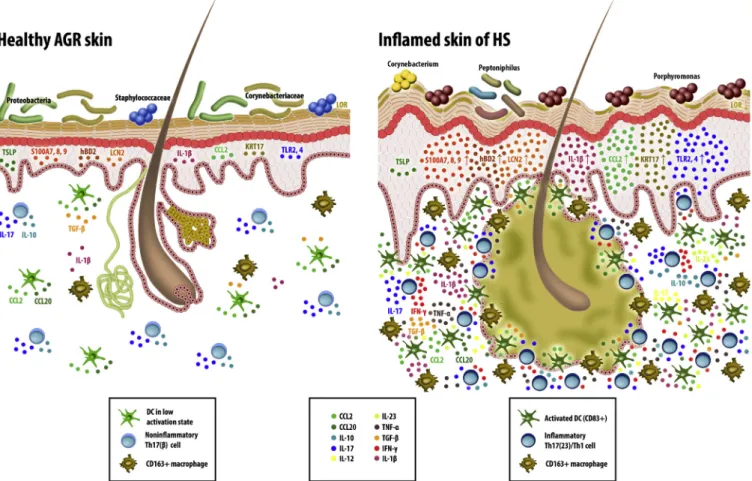 Figure 1. Apocrine gland e rich skin has a non-inflammatory IL-17 e related immune milieu, which turns to inflammatory IL-17 e mediated disease in hidradenitis suppurativa