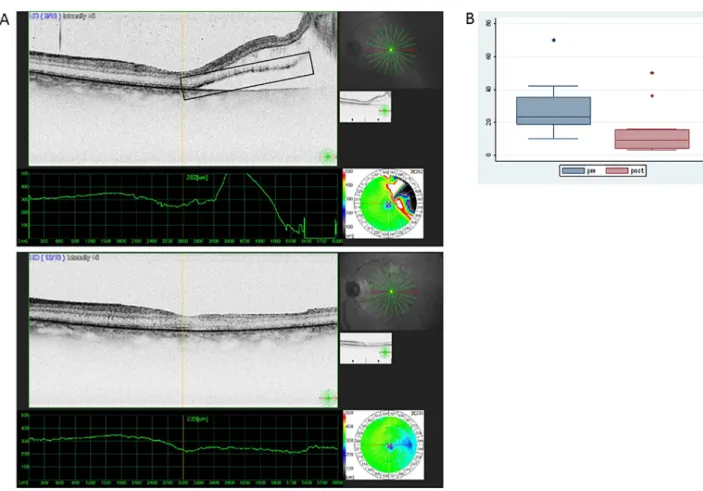 Fig 1. Presence of HR points in the retina before and after surgery for rRD. (A) HR points are shown in the square box