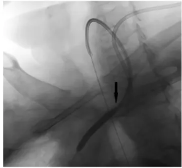 1. ábra Preoperatív állapot. A bal kulcscsont feletti feltárás sebében lát- lát-hatók a lefogott katéterszárak