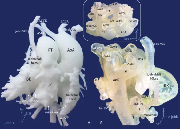 4. ábra A szív és a nagyerek 3D-modelljei (11. eset). Dextrocardia (tükörképhelyzet), visceralis heterotaxia, kétoldali VCS, a VCI hiánya és az alsó testfél  vénás beáramlása a v