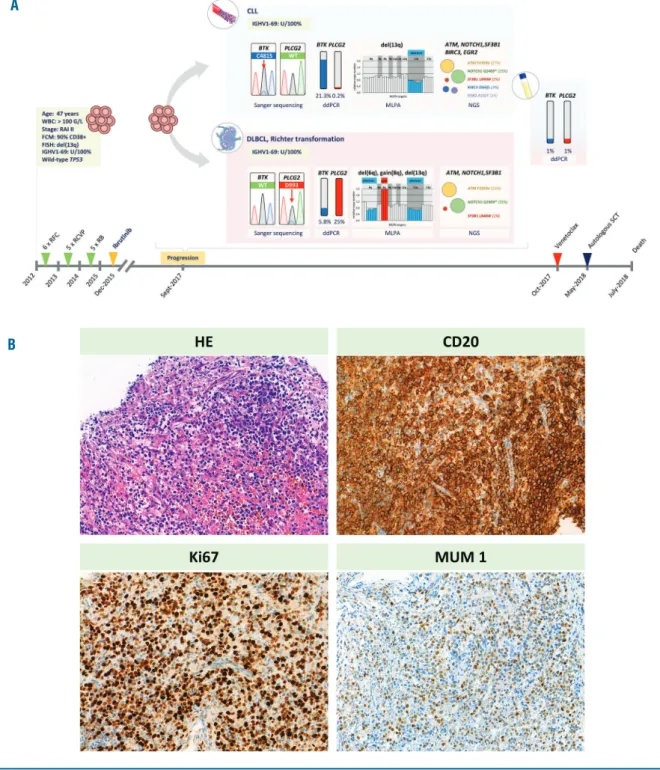 Figure 1. Detailed illustration of the clinical and genetic events at ibrutinib relapse and histological features of the transformed disease