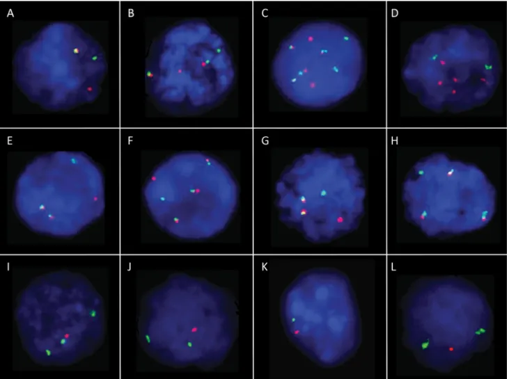 3. ábra Abnormális FISH-jelmintázatok plazmasejtes myelomában. A) Az immunglobulin-nehézlánc (IGH)-gén törésére utaló disszociációs jelmintázat