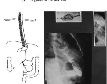 1. ábra Primer GEA konverziója Billroth I. reszekcióra GEA = gastroenteroanastomosis