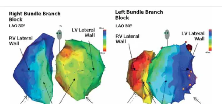 FIGURE 1. Electrical activation of the left and right ventricle in patients with right bundle branch block and left bundle branch  block (2)
