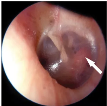 1. ábra A hallójáraton keresztül készített endoszkópos fotó, melyen a  dobhártya hátsó-alsó negyede alatti finoman vörhenyes  erezett-ség látszik, amelyet a promontoriumra terjedő otoscleroticus  góc okoz