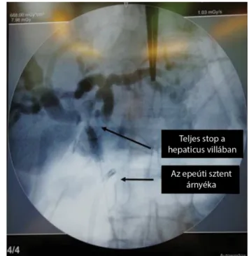 1. ábra Az első beteg CT-képe a vena cava inferiort infiltráló és mecha- mecha-nikus icterust okozó I