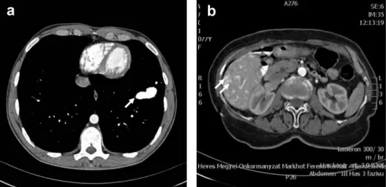 4. ábra Arteriovenosus malformatiók (AVM) kontrasztanyagos CT-képe HHT-betegekben. (a) 22 éves férfi beteg (HeP1-család) mellkas-CT-felvételén a bal  tüdő VIII