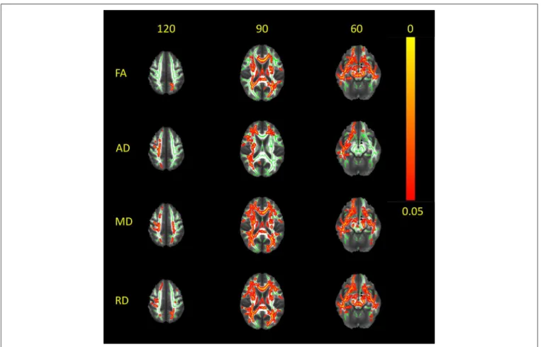 FIGURE 2 | White matter alterations in RTLE as compared to normal controls. Red-yellow clusters indicate statistically significant results in patients: widespread clusters of reduced FA as depicted in the center of fiber bundles, paralleled with increased 