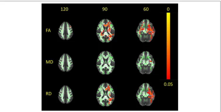 FIGURE 3 | White matter alterations in LTLE as compared to normal controls. Red-yellow clusters indicate statistically significant results in patients: clusters of reduced FA and increased RD in the center of main fiber bundles (along with focal clusters o