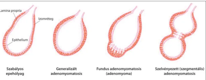 4. ábra. Az adenomyomatosis formái