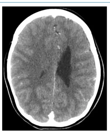 Figure 3. Cranial computed tomography scan. During headache, the left lateral ventricle shows only moderate dilatation.