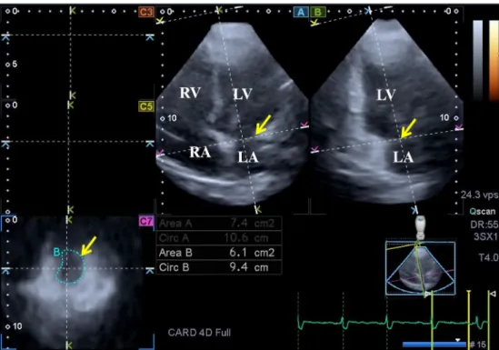 Figure 1 Images from a 3D full-volume dataset presenting the MA in a patient with repaired TOF: (A) Apical four-chamber view; (B) apical  two-chamber view and a cross sectional view at the level of the MA (C7) optimized on apical four- and two-chamber view