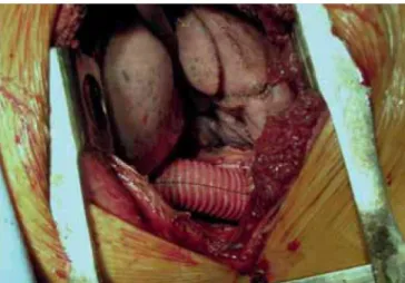 7. ÁBRA. Az aortainterrupció áthidalásának műtéti  képe