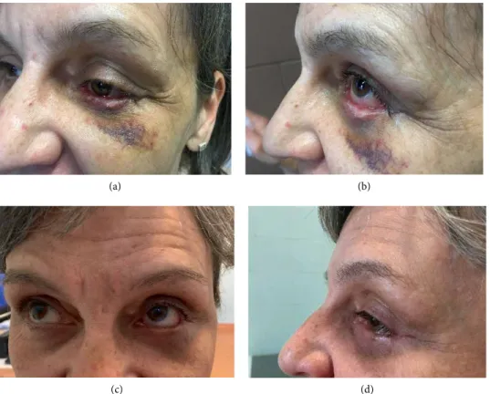 Figure 2: Clinical appearance of the left lower eyelid 1 week (a) and (b) and 2 months (c) and (d) after tumor removal and surgical reconstruction  of the excised area.