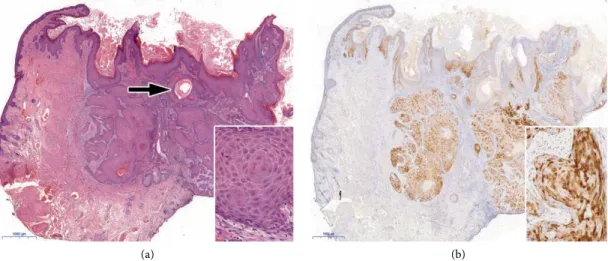 Figure 3: Histopathological features. (a) Hyperkeratotic epidermis and endophytic epithelial growth into the dermis with squamous pearl  (arrow)