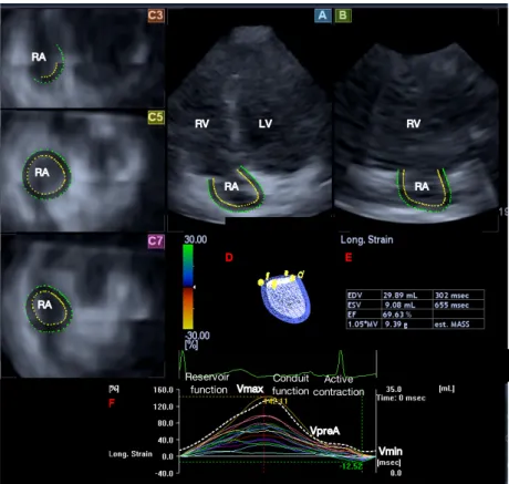 Figure 1 3D-STE image of a typical patient: apical four-chamber (A), two-chamber views (B) and short-axis views at basal (C3), midatrial (C5)  and superior (C7) levels of the RA