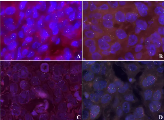 Fig. 1   LAPTM4B FISH images  in anthracycline-treated cases. 