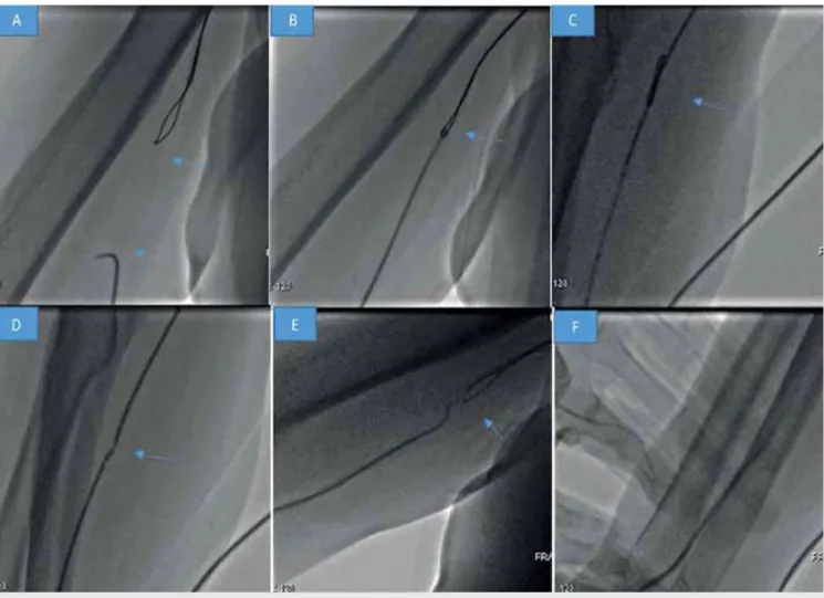 2. ÁBRA. Panel A,  B:  multipurpose 6F (Medtronic,  Usa)  katétert vezetünk  a jobb arteria femoralis  behatolás felől  a  brachialis ar­
