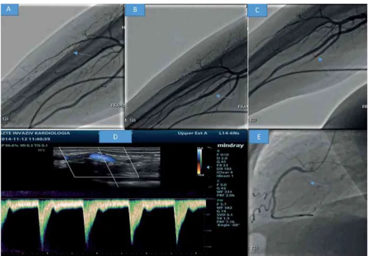 3. ÁBRA.  Panel A,  B, C: A z arteria  brachialis felől végzett artériás angiográfia  nem  mutat érsérülést, vagy elzáródást (nyilak)