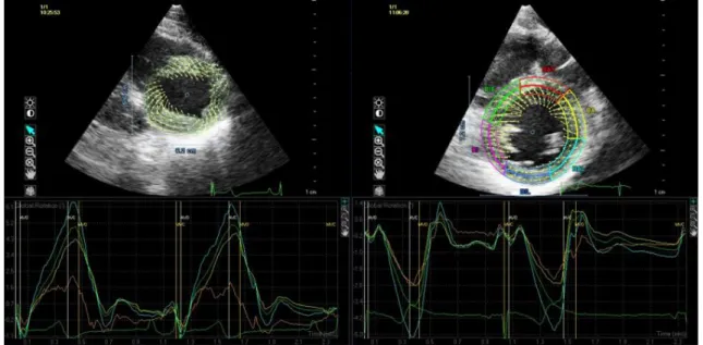 Figure  1.  Assessment  of  apical  and  basal  rotation  by  speckle  tracking  echocardiography