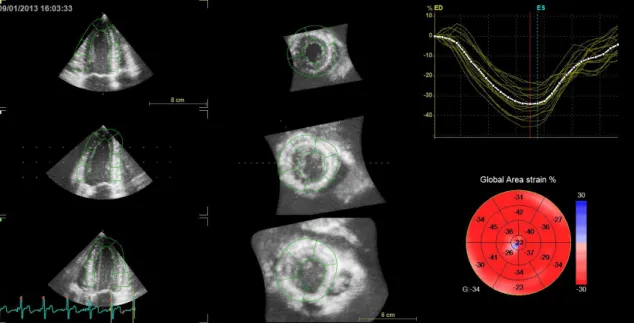 Figure  2.  Representative  3D  speckle  tracking  analysis.  Using  the  standard  model of the left ventricle, the software calculates the segmental strain values in  every  available  timepoint  of  the  cardiac  cycle