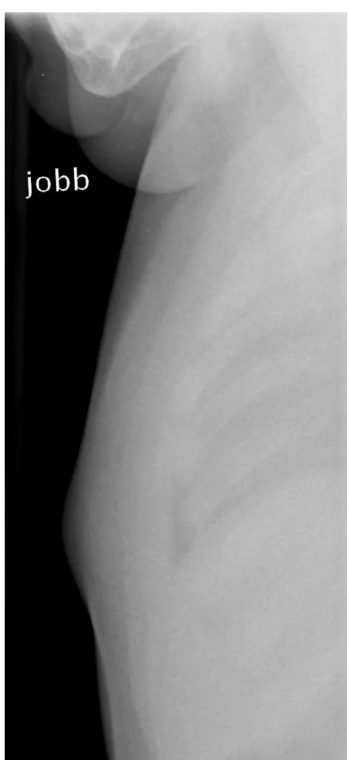 Az  elvégzett  oldalirányú  röntgenfelvételen  (2. ábra)   a  még  porcos  sternum  felett  lágyrész‐duzzanat  látszott,  a  csontokon  kóros eltérést nem tudtunk igazolni.