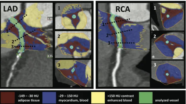 Figure  1  -  Threshold  based  volumetric  pericoronary  adipose  tissue  quantification  (left  panel: LAD, right panel: RCA)