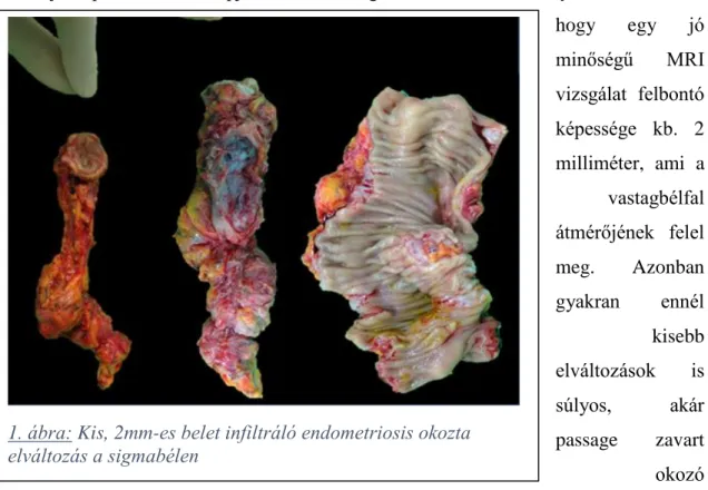 1. ábra: Kis, 2mm-es belet infiltráló endometriosis okozta  elváltozás a sigmabélen 