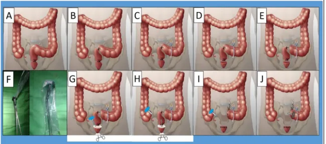 7. ábra: A transrectalis specimen eltávolítás munkacsoportunk által kidolgozott lépései 