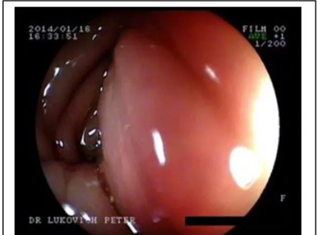 11. ábra: Bélendometriosis okozta  benyomat a bélen 