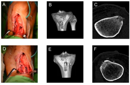 2. ábra   Tibia csonthiány létrehozása és feltöltése. A felső sorban a feltöltés nélküli műtéti kép,  valamint a csupán autograftal feltöltött tibia 3D CT rekonstrukció és reprezentatív axiális CT szelet  látszik