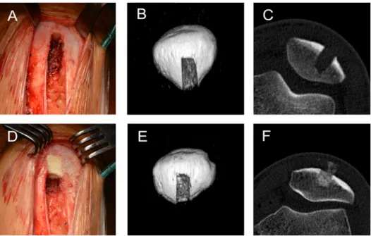 Fig. 1. Patella donor site filling techniques. Panels A, B, and C show the control technique in an  intraoperative picture and 1 week post-operative CT images