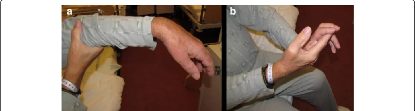 Fig. 1 Isolated central weakness of the left upper extremity. Wrist drop (a) and decreased handgrip strength (b)