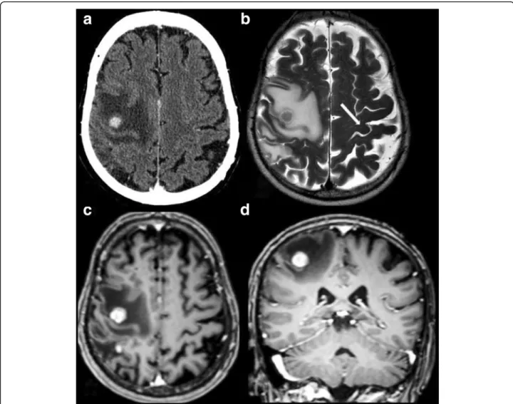 Fig. 2 Contrast-enhanced axial CT (a), T2W axial MR (b), contrast-enhanced T1W axial (c) and coronal (d) MR