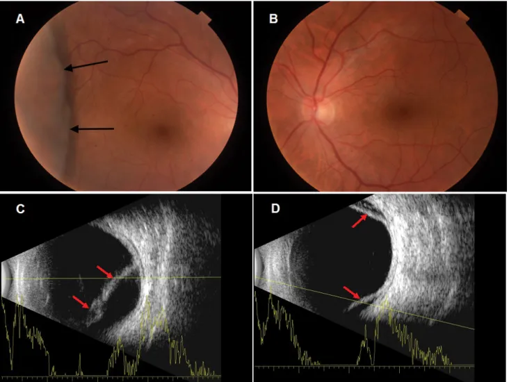 2. ábra Második beteg szemeiről készült fundusfotók és B-scan ultrahangfelvételek. A jobb (A) szem temporalis periférián lévő chorioidealeválásának határát  a fekete nyilak mutatják, a bal (B) szemen a chorioidealeválás annyira perifériás volt, hogy nem le