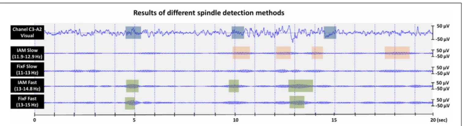 FIGURE 3 | Visual and automatic sleep spindle detections in a 20 s N2 sleep segment recorded from a healthy adult male