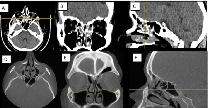 1. ábra Az orrmelléküregek CT-vizsgálata. Az ostiomeatális egység a coronalis síkban vizsgálható a legjobban