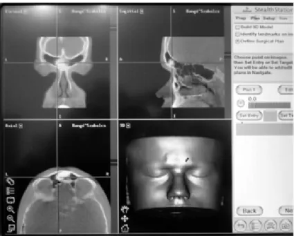 5. ábra Homloküregi osteoma műtéti eltávolítása CBCT alapján, navigáció segítségével. Fix referenciapontok kijelölése