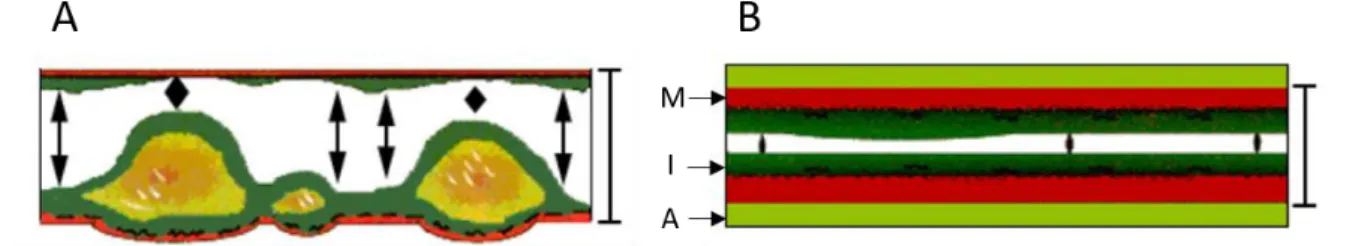 2. ábra. Az atherosclerosis és a cardialis allograft vasculopathia által érintett  érszakok jellegzetességei  