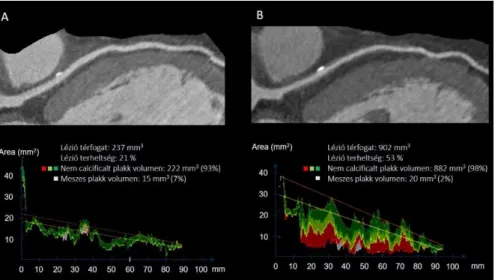 3. Ábra Kvantitatív coronaria fal analízis szívtranszplantált beteg követéses  CT  felvételei  alapján