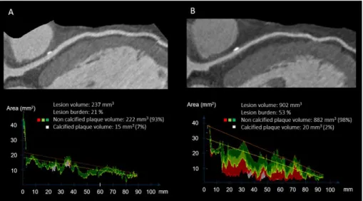 Figure 3. Coronary lesion tissue volumes at baseline (A) and at follow-up (B) of the  same HTx patient quantified with dedicated software